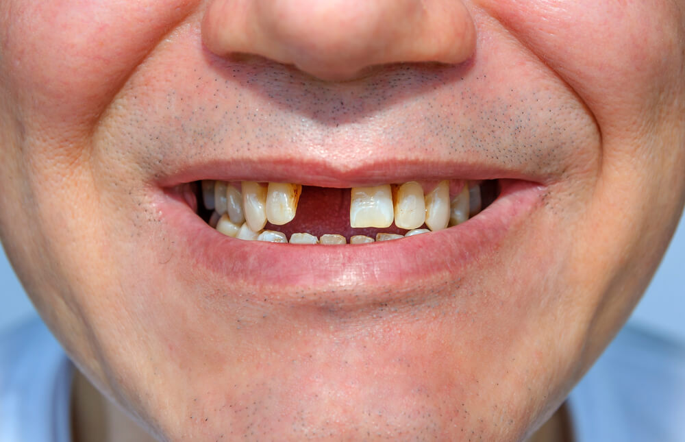 smiling man gap teeth.